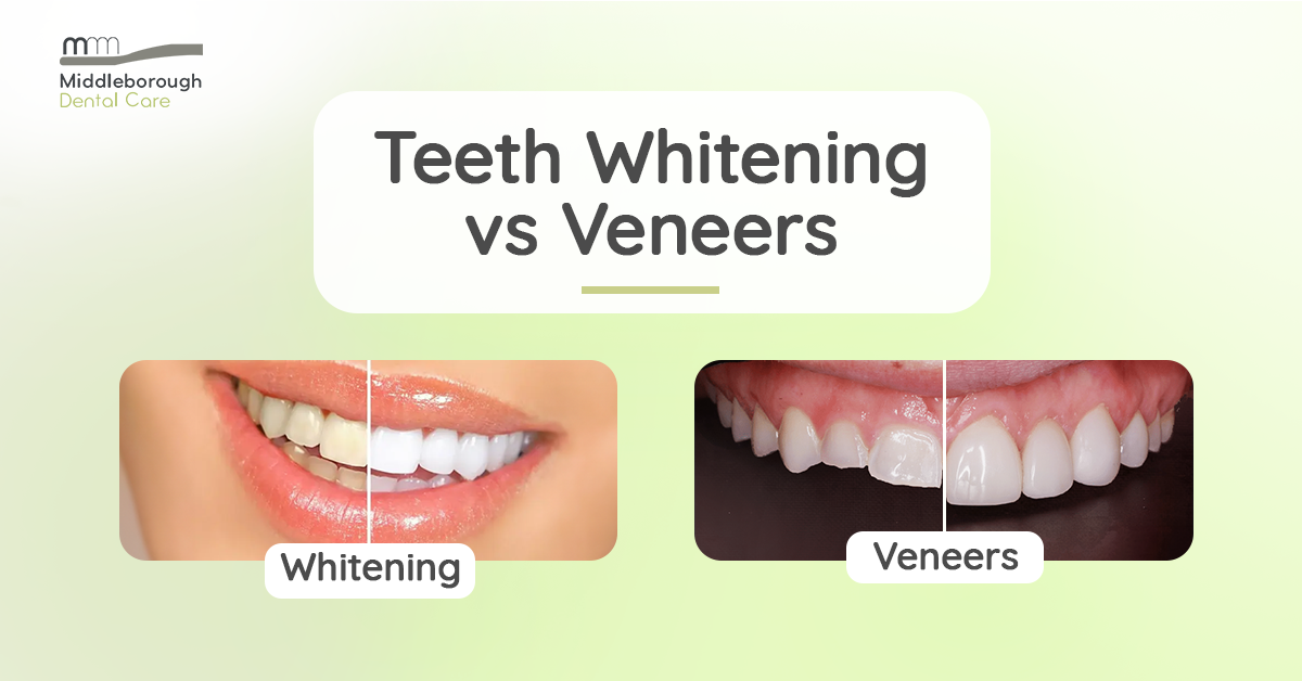 What you should consider when comparing teeth whitening to veneers ...